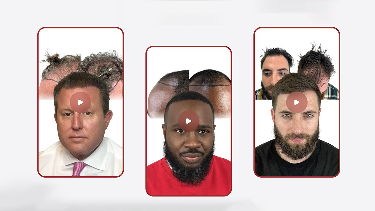 Maxim Hair Restoration Is Shaping a New Era of Personalized Hair Restoration